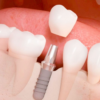 Implantes dentales Bogota