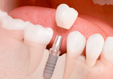 Implantes dentales B...