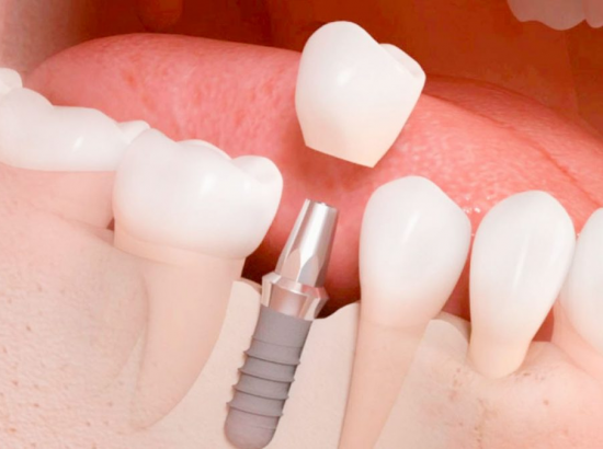 Implantes dentales Bogota 