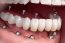 Implantes dentales B...