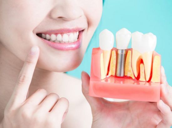 Implantes dentales Bogota 
